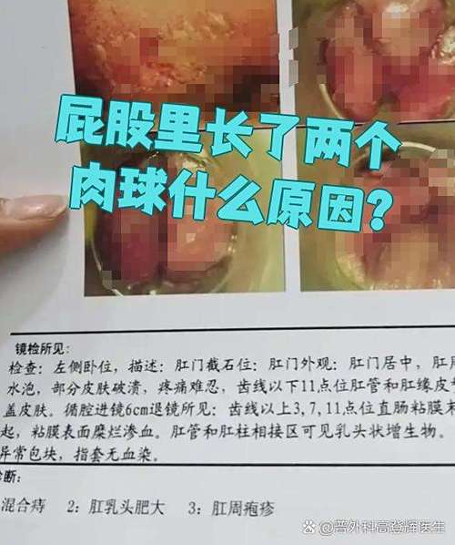 肛门肉球脱出用什么药能治好