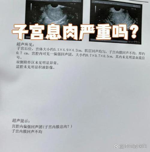 子宫息肉严重吗