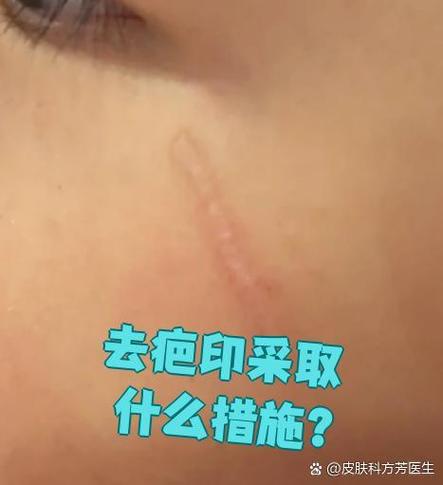 去疤印用什么方法最好