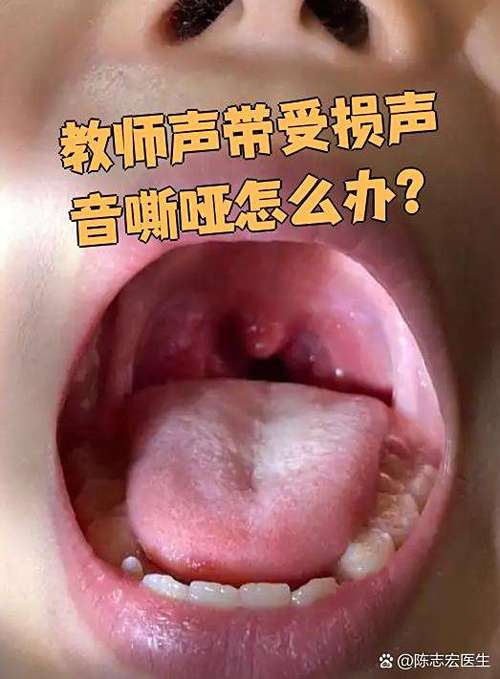 ktv唱歌嗓子很快就哑了