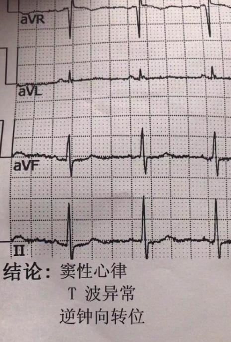 心脏逆钟向转位是什么意思