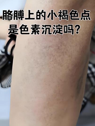 黑色素沉淀