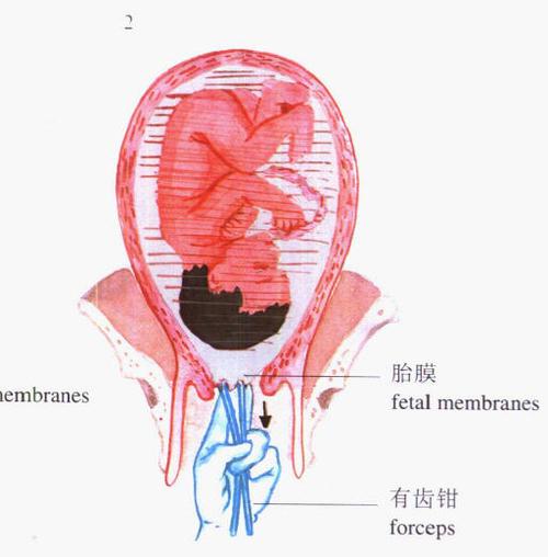 人工剥膜的危害