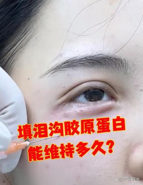 眼袋填充胶原蛋白能保持多久