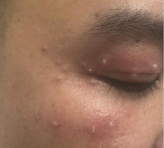 女生感染hpv初期症状截图