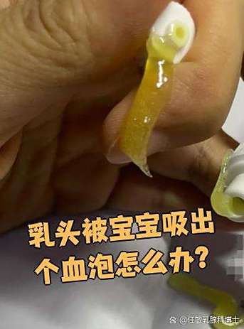 奶里有血丝宝宝能喝吗图标