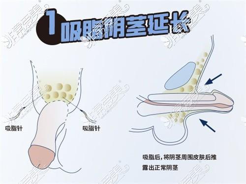 男生可以做增大手术吗