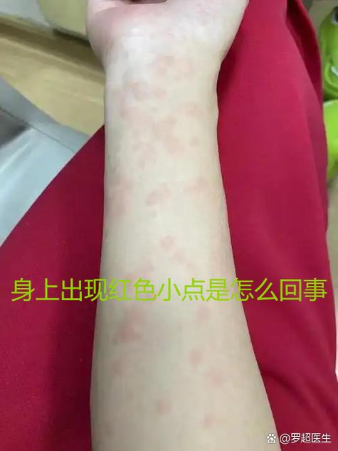 身上起红色点点不痛不痒越来越多