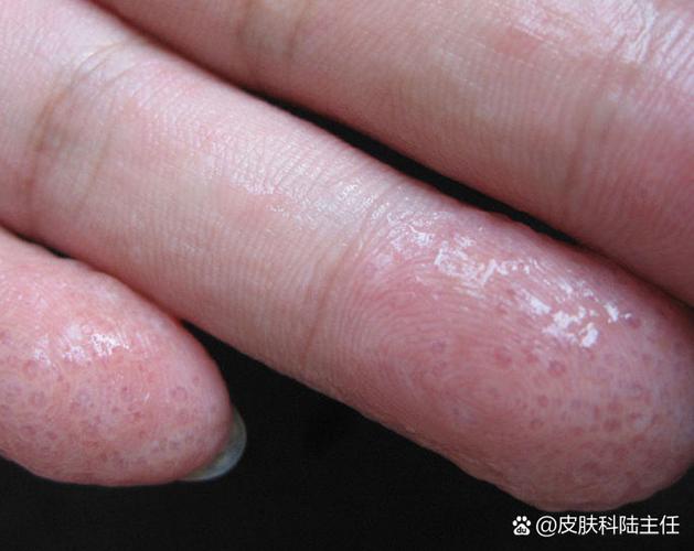 真菌感染的症状