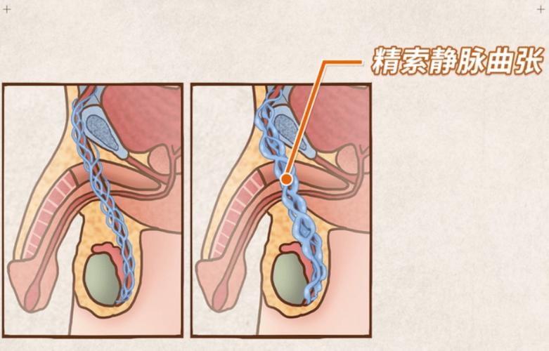 精索封闭治疗的弊端