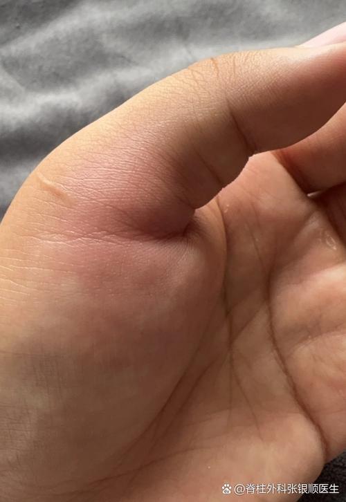 手指头突然跳痛