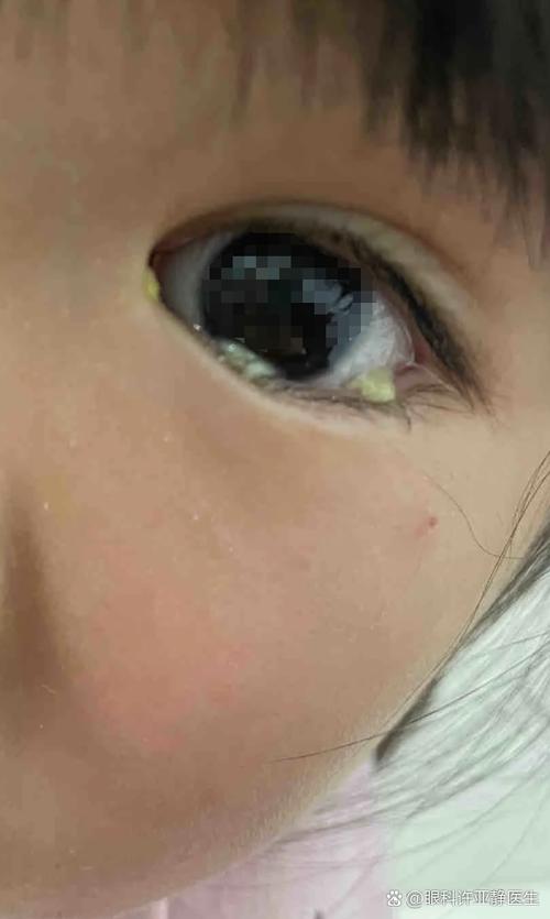 婴儿眼睛眼屎多又黄粘稠什么原因