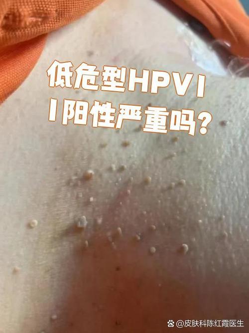 低危hpv11好清除吗