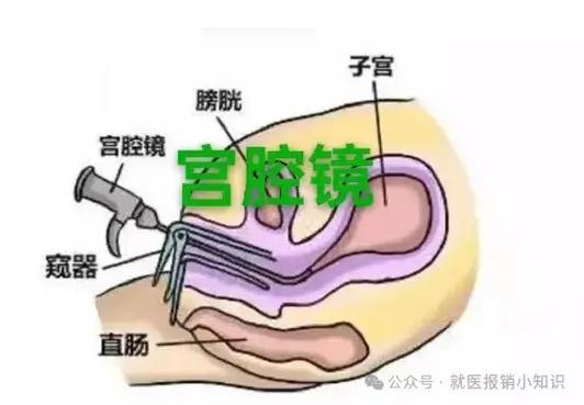 宫腔镜手术和腹腔镜手术的区别