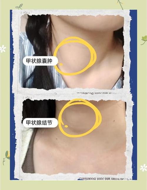 甲状腺缩略图