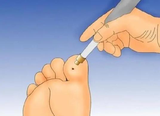 脚痒怎么办