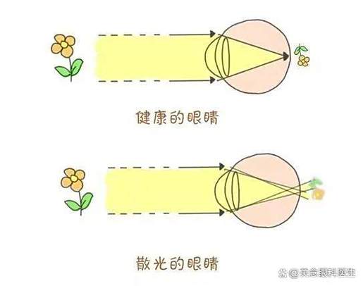 散光300度可以矫正过来吗