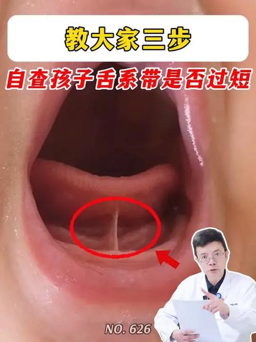 舌系带短