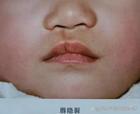 面横裂隐裂