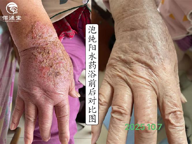 80岁老人湿疹要警惕图标
