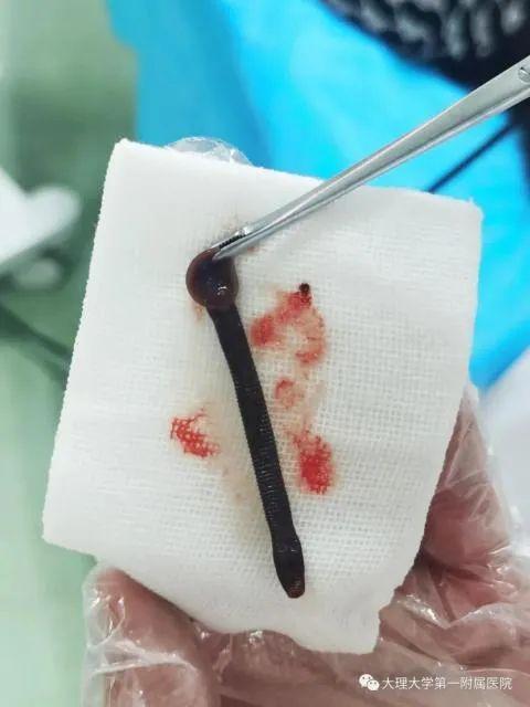 流鼻血的时候拉出一条很长的东西