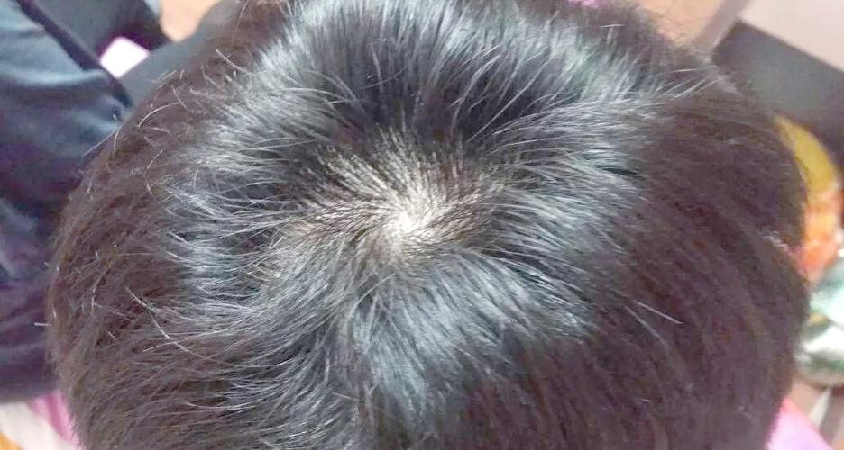 头发发旋