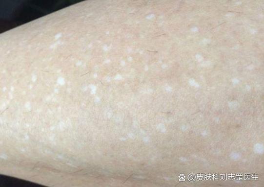 白圈消除方法详解