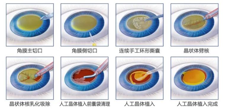 白内障到什么程度做手术最好