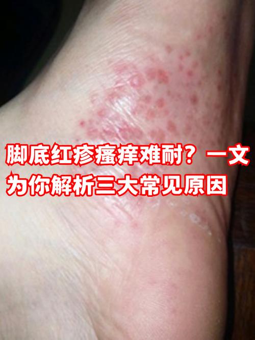 脚心痒越抓越痒怎么回事