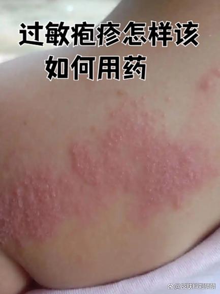 铍立安皮肤抑菌膏是激素药吗