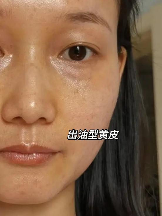 脸发黄是什么原因造成的缩略图