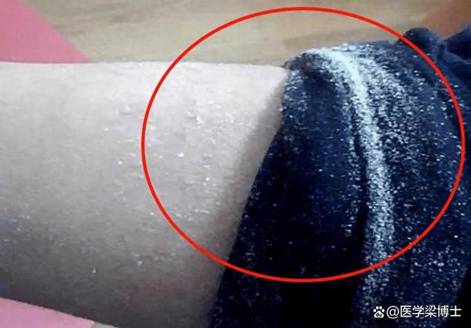 一脱秋裤一大堆皮屑
