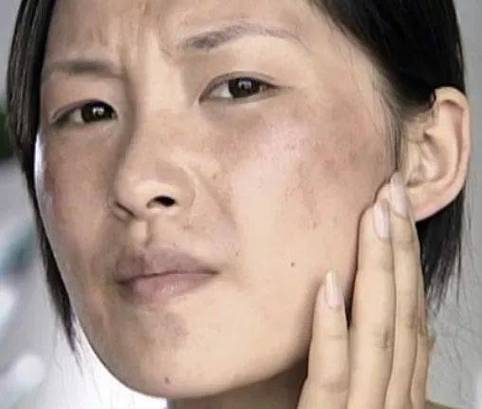 人脸泛黄是为啥