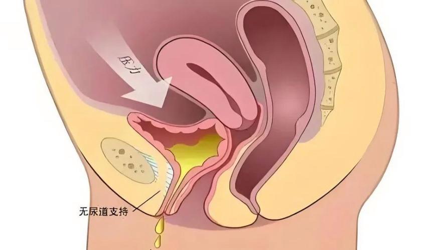 女子尿急失禁