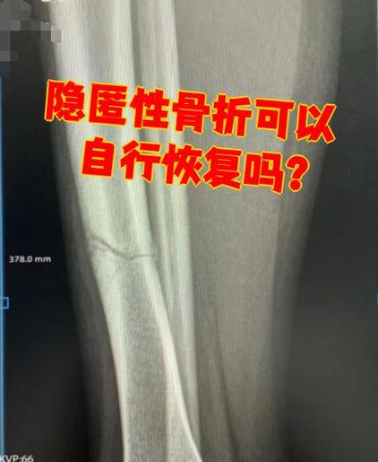 骨折自己能自愈吗