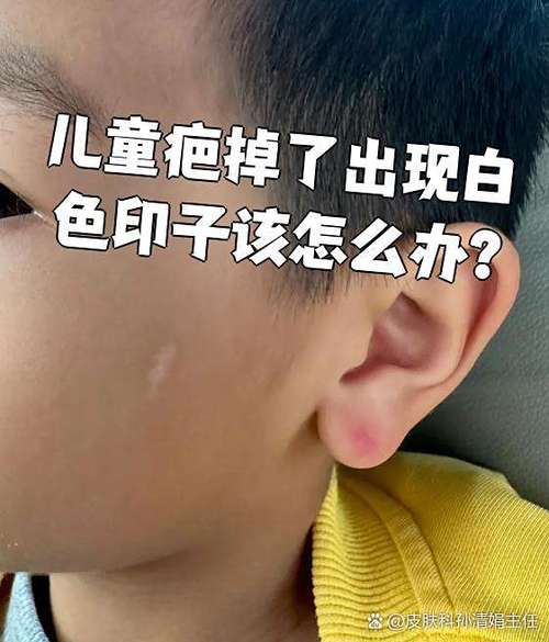 掉痂后的白印是疤痕吗截图