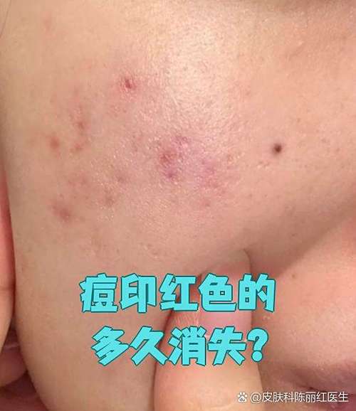 红痘印一般多久会消失