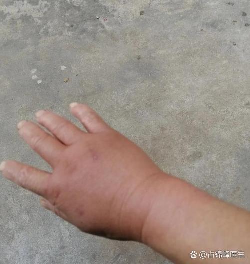 手肿成猪蹄表情包