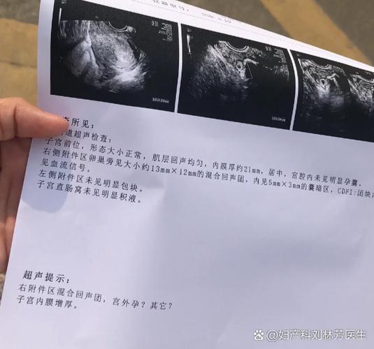 宫外孕会是一条杠吗截图
