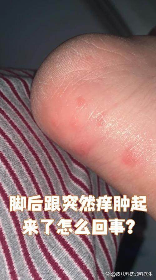 脚后跟痒截图