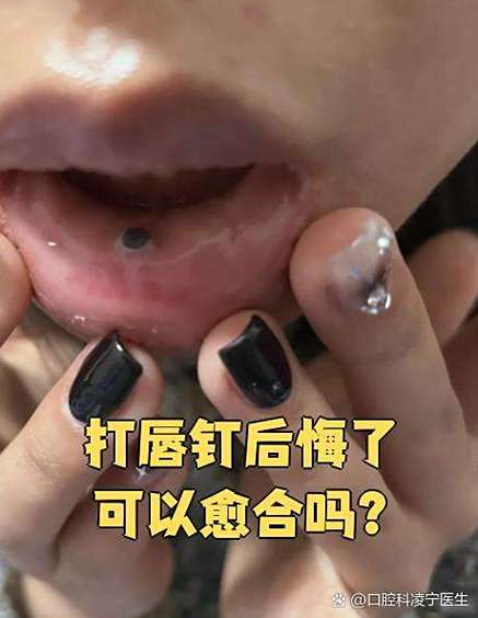 小南嘴巴下面的是唇钉还是痣