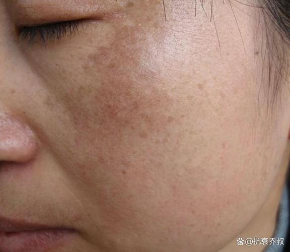 脸上黑斑如何去掉偏方