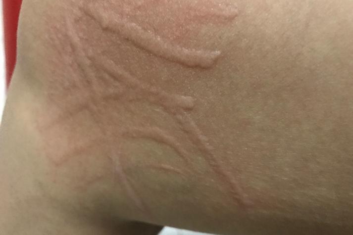 皮肤上出现类似抓痕的长条状