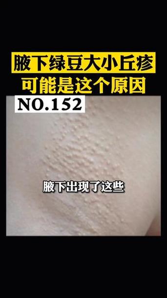 咯吱窝起密密麻麻的小疙瘩截图