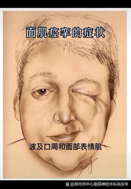 面肌痉挛的症状及治疗方法