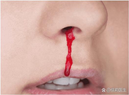 突然流鼻血要马上采取什么措施