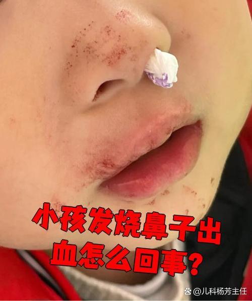 只流鼻血没有其他症状截图