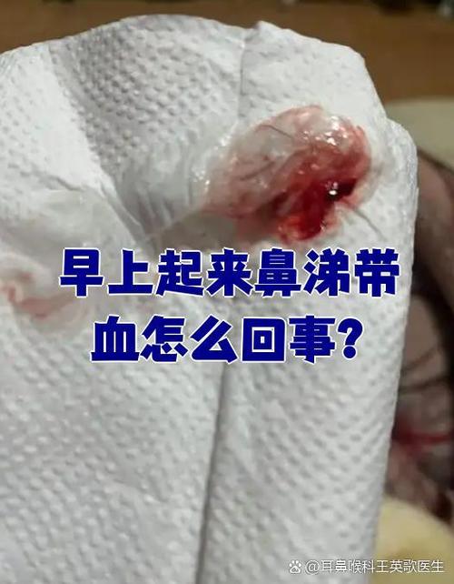 擦鼻涕都是血怎么回事