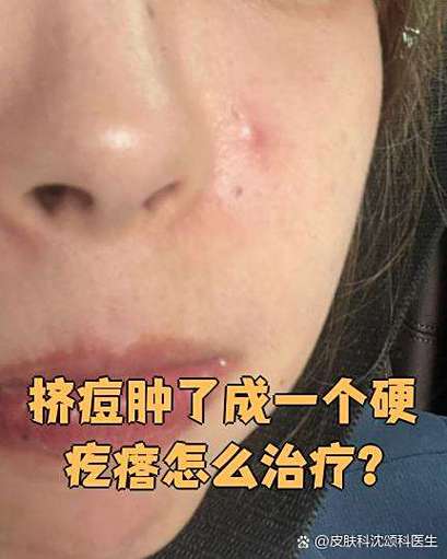 挤痘痘留下的硬结怎么消除