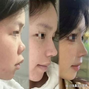 小时候塌鼻子长大后会挺吗